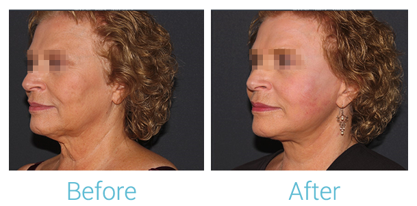 Facelift Before & After Gallery - Patient 58152102 - Image 4