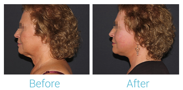 Facelift Before & After Gallery - Patient 58152102 - Image 5