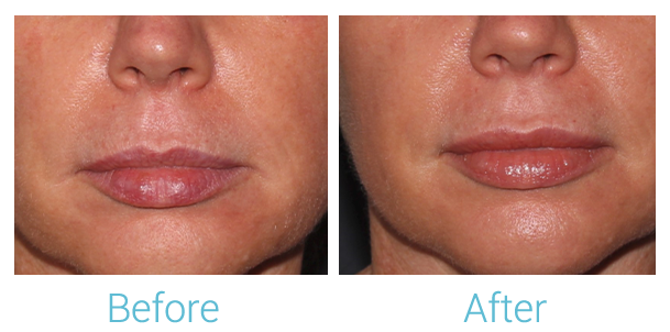 Fillers Before & After Gallery - Patient 58152127 - Image 1