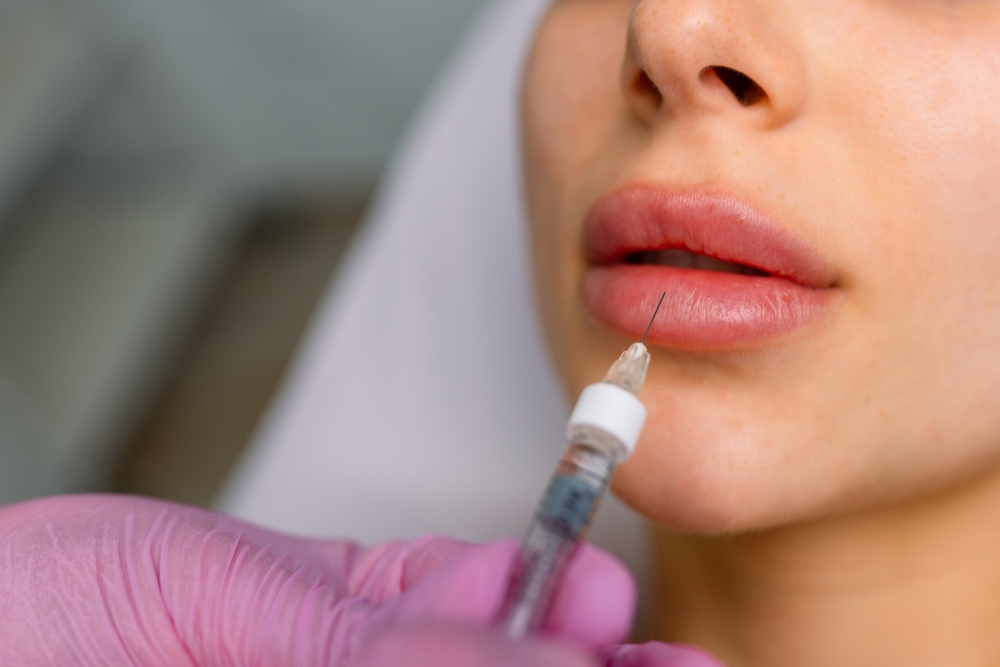 Lip Filler Cost in Bel Air, Maryland