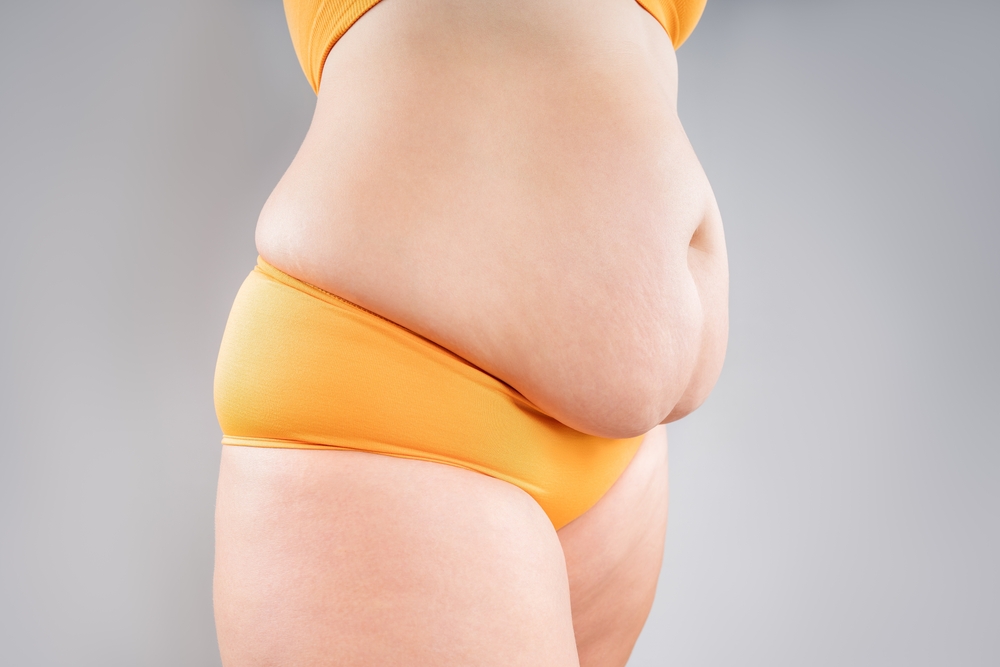 Tummy Tuck